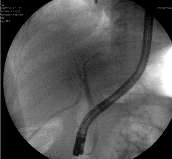 choledocholithiasis ercp