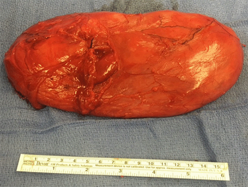 Spindle cell lipoma. (A) A fatty-tumor with interspersed fibro-myxoid