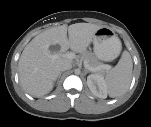 Surgical Management of an Intrahepatic Type II Choledochal Cyst | ACS