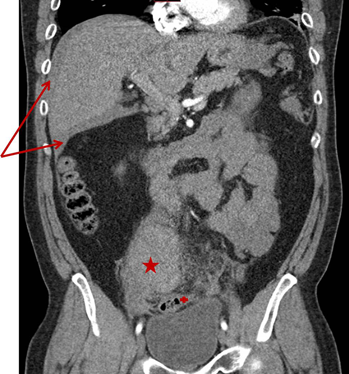 Spontaneous Hemoperitoneum In Sigmoid Diverticular Disease Acs 5324