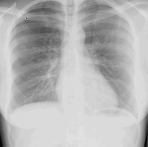 hemo pneumothorax x ray