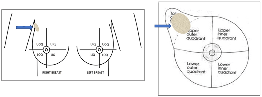 how-to-diagnose-sharp-pain-in-breast-bloglabcity