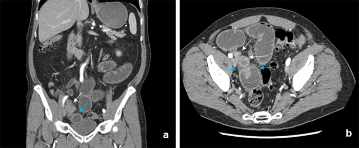 Appendiceal Adenocarcinoma Presenting as Recurrent Small Bowel ...