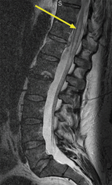 Delayed Massive Hemothorax and Paraplegia Complicating Endovascular ...