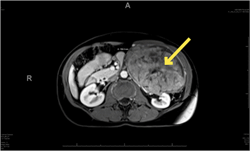 Renal Leiomyoma in a Symptomatic 54-Year-Old Woman | ACS