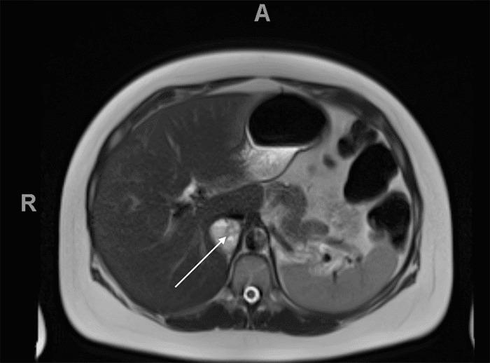 Pheochromocytoma In Late Pregnancy Associated With Genetic Mutation 