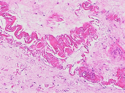 Spindle cell lipoma. (A) A fatty-tumor with interspersed fibro-myxoid