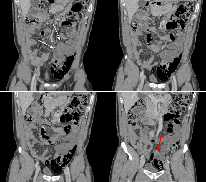 Adhesive Small Bowel Obstruction Secondary to Anisakiasis Nematode ...