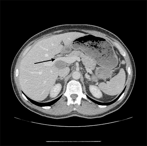 High-grade Neuroendocrine Carcinoma Of The Gallbladder Presenting As 