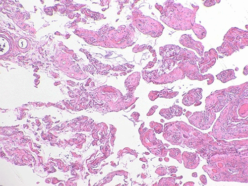 Spindle cell lipoma. (A) A fatty-tumor with interspersed fibro-myxoid