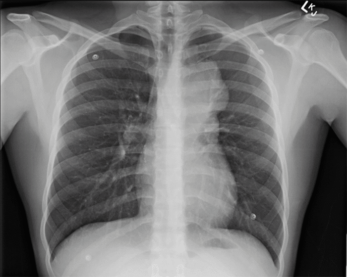 The Chamberlain Procedure to Diagnose Primary Mediastinal Seminoma ...