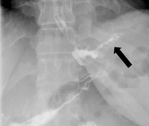 A Minimally Invasive Approach to Persistent Gastric Staple-Line Failure ...