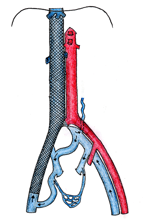 Successful Renal Transplant From A Deceased Donor In A Patient With 