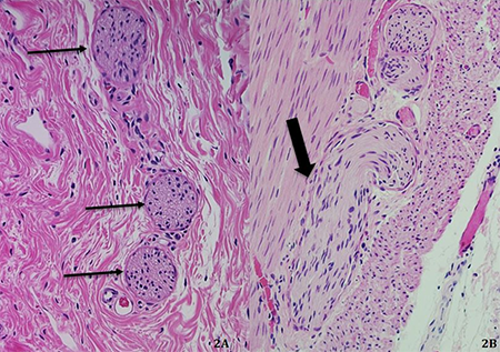 Concomitant Duodenal Atresia and Hirschsprung Disease | ACS