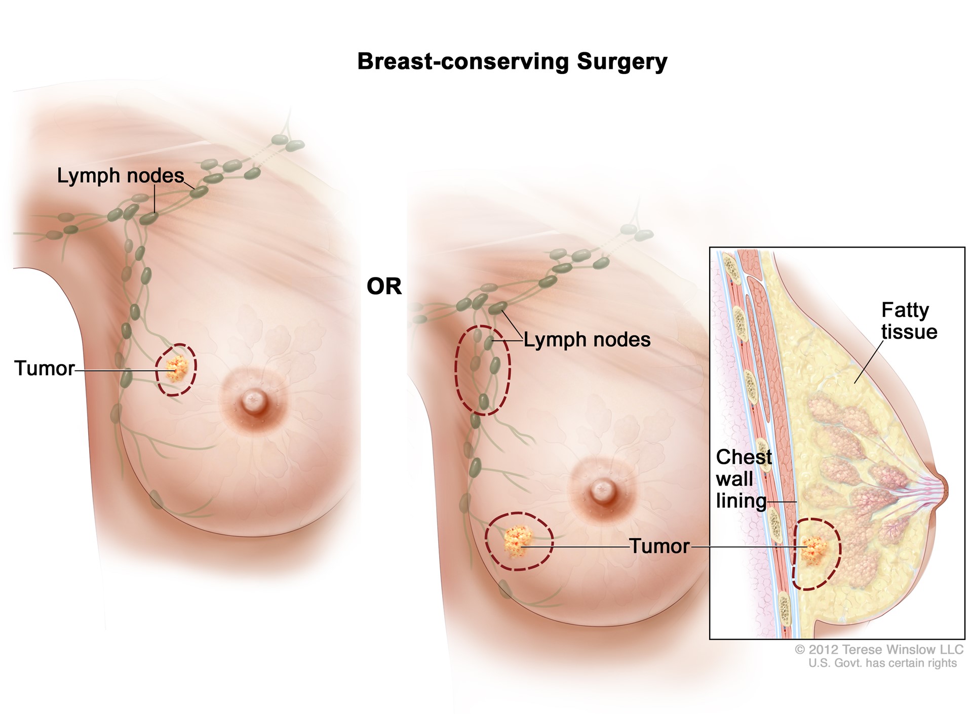 Breast Conserving Surgery Lumpectomy ACS