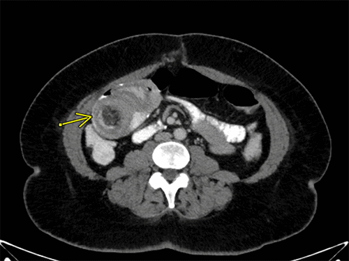 Recurrent Retrograde Intussusception Despite Revision Of Jejunojejunal