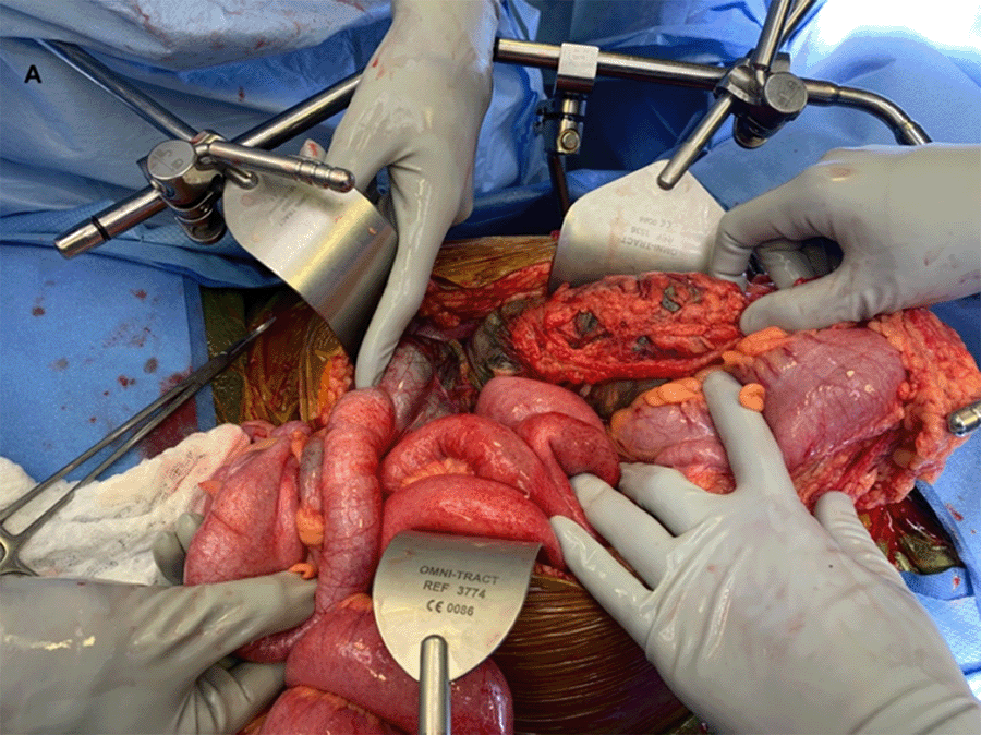 Abdominal Compartment Syndrome