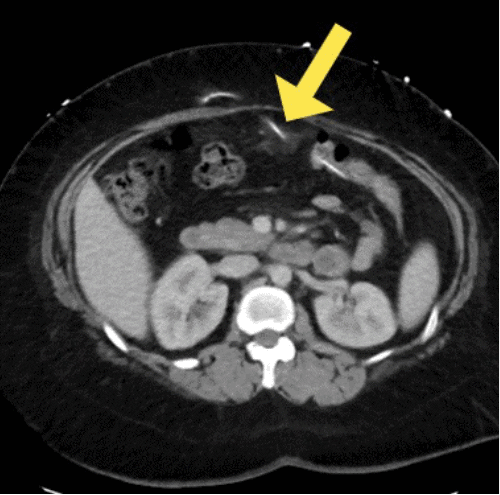 Laparoscopic Management of Ventriculoperitoneal Shunt Intracolonic ...