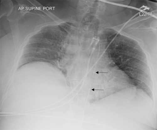 The Evolution of REBOA: Successful Use of Resuscitative Endovascular ...