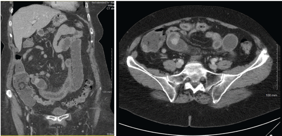 Rare Jejunal Tumor Presenting with a Common Condition | ACS