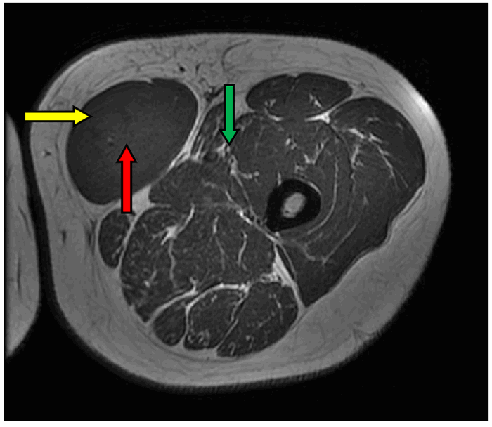 Leiomyosarcoma Arising from the Great Saphenous Vein | ACS