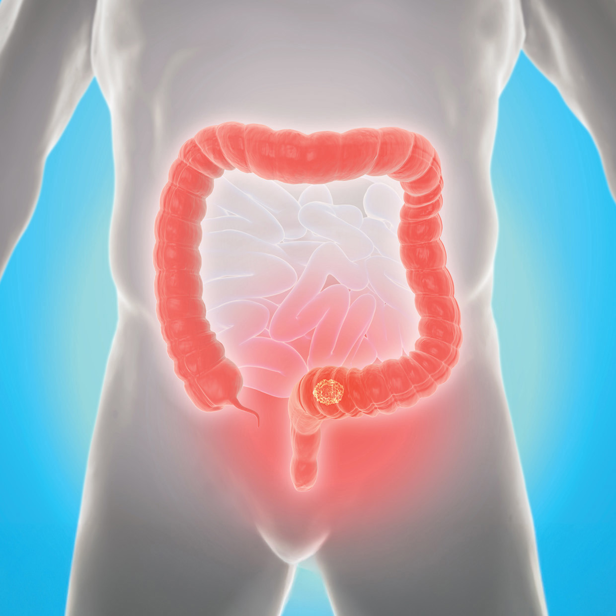 Clinicians Struggle to Understand Dramatic Rise in Early Onset Colorectal Cancer