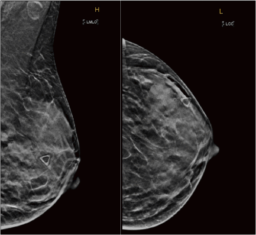 Rare Presentation of Pure Mucinous Carcinoma of the Breast: HER2 ...