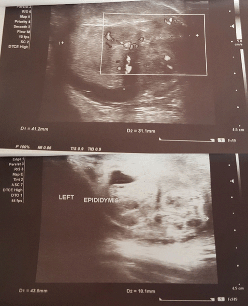 Unilateral Tuberculous Epididymo-orchitis With Scrotal Fistula