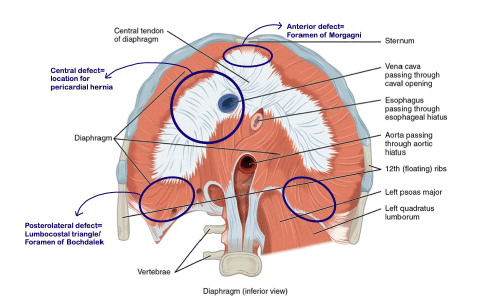 Traumatic Diaphragmatic Rupture and the Delayed Presentation of a ...