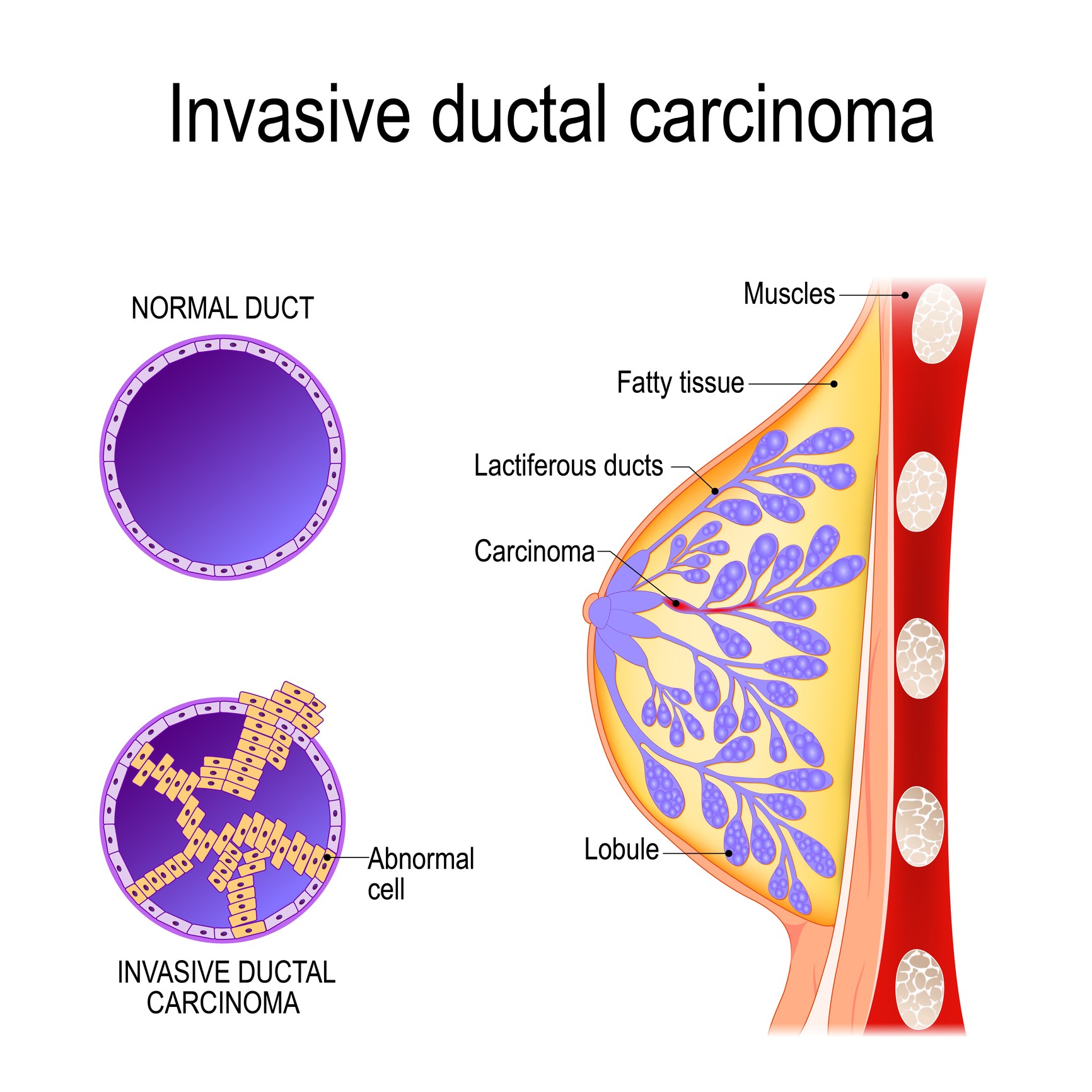 Invasive Breast Cancers ACS