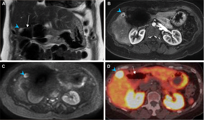 Pancreaticobiliary Reconstruction Limb Ulcers Following Transarterial ...