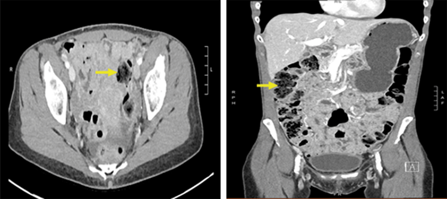 Rectosigmoid Intussusception As A Rare Manifestation Of Colorectal