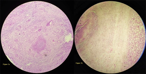 Unilateral Tuberculous Epididymo Orchitis With Scrotal Fistula Acs