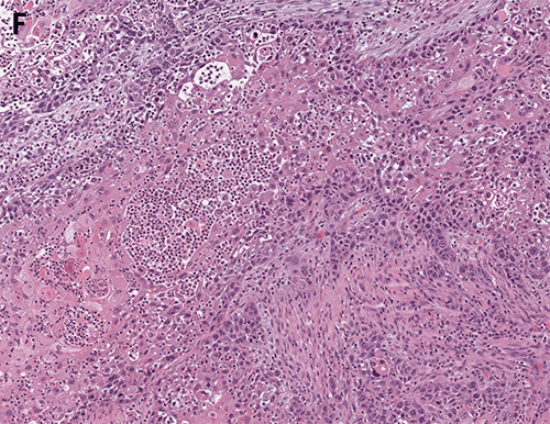 Squamous Cell Carcinoma of the Breast in the Setting of a Chronic ...