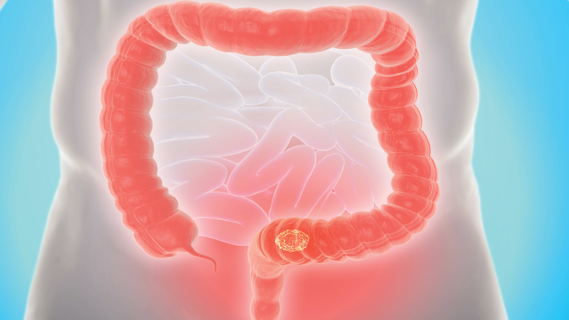 Rise in Early Onset Colorectal Cancer