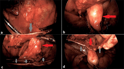 Rare Concurrent Obturator and Sciatic Hernia: Pathophysiology, Diagnosis,  and Management