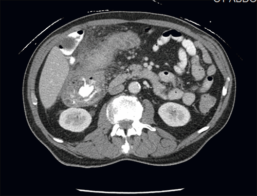 A Rare Case Of Abdominal Actinomycosis Mimicking Cancer 