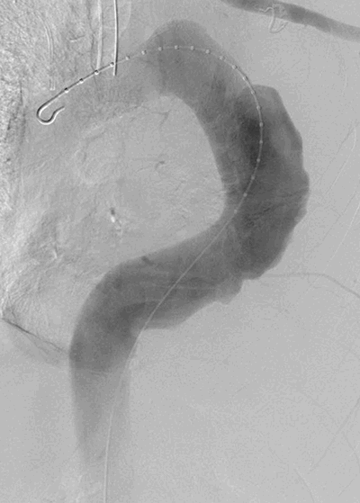 Misplacement of an Internal Jugular Chemo-Port into the Epidural Space