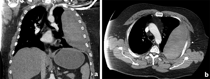 Traumatic Extrapleural Hematoma with Delayed Presentation Resulting in ...