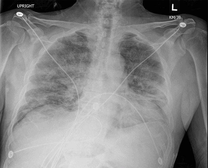 Colonic Paralytic Ileus in COVID-19 Patients | ACS