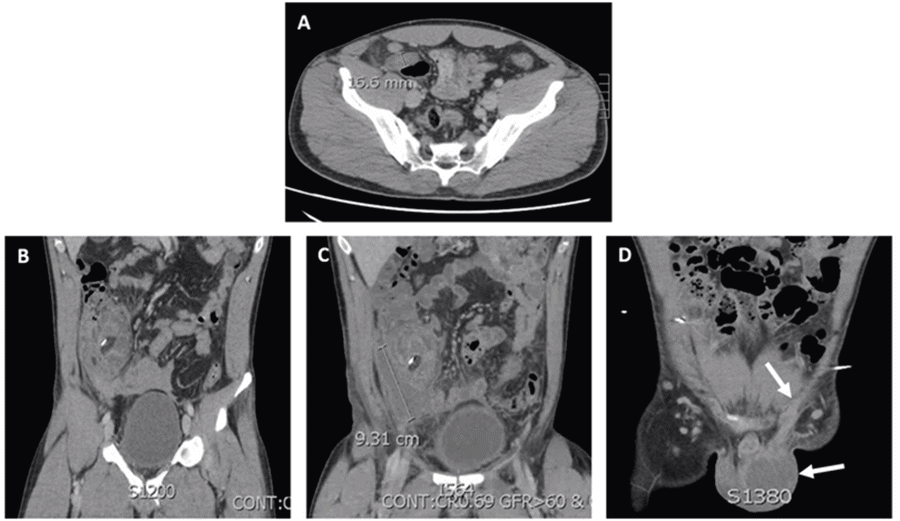 Hydrocele with Subsequent Scrotal Abscess in a 29-Year-Old Male After ...