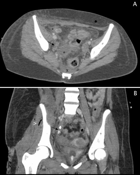 Juvenile Dermatomyositis In Remission Complicates Appendicitis: A Case ...