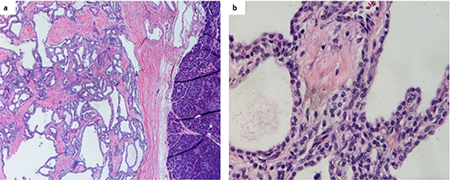 Multifocal Solid and Serous Cystadenomas and a Neuroendocrine Tumor of ...