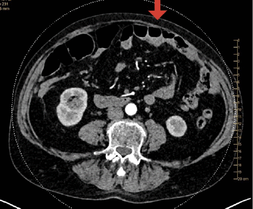 Deep Venous Thrombosis After Repair of Abdominal Bulge with Fascial ...