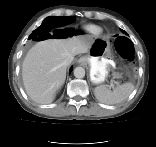 Postpartum Bowel Perforation after Normal Vaginal Delivery without ...