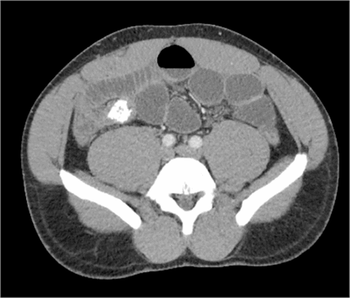 Acute Small Bowel Obstruction Caused by Ingestion of Chicken Bones