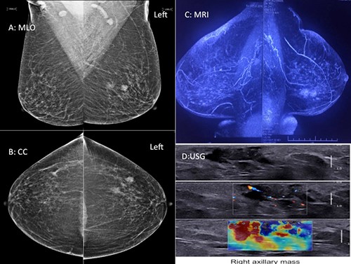 Bilateral Breast Cancer: Different In More Ways Than One | ACS