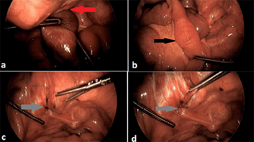 Incarcerated femoral hernia with small bowel obstruction