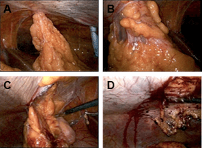 Ogden Inguinal Hernia Repair, Treatment & Surgery