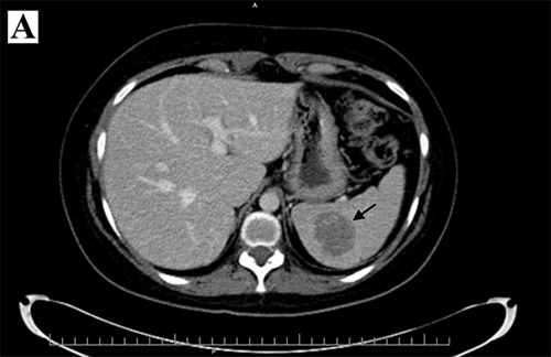 Sclerosing Angiomatoid Nodular Transformation of the Spleen | ACS